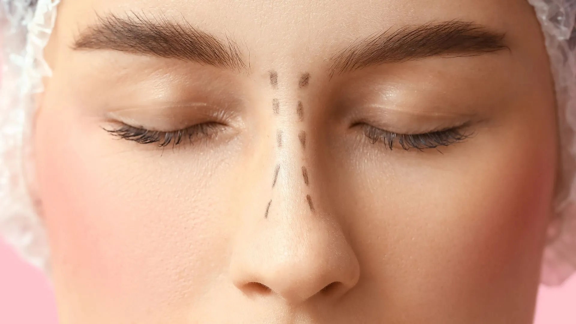 Revision-Rhinoplasty_-_-Selcuk-Inanli