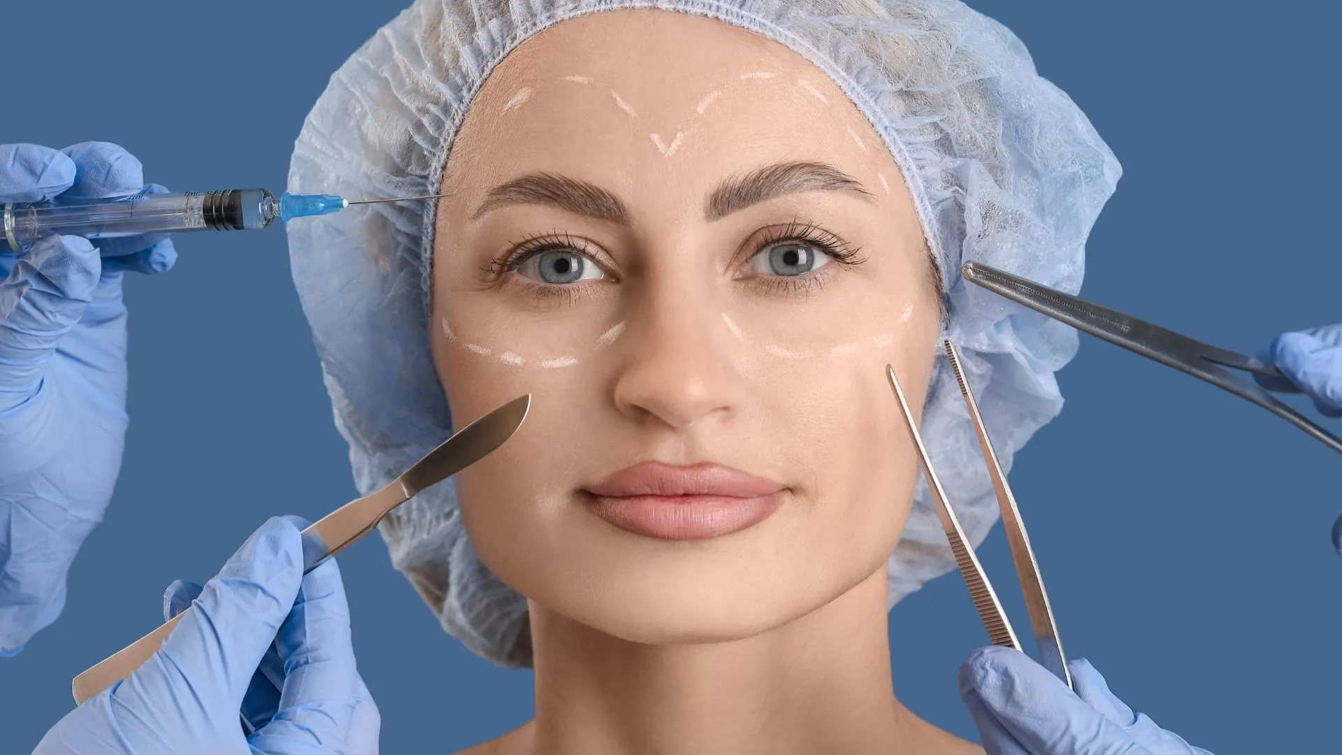 blepharoplasty-upper-eyelid-_-Selcuk-inanli_1