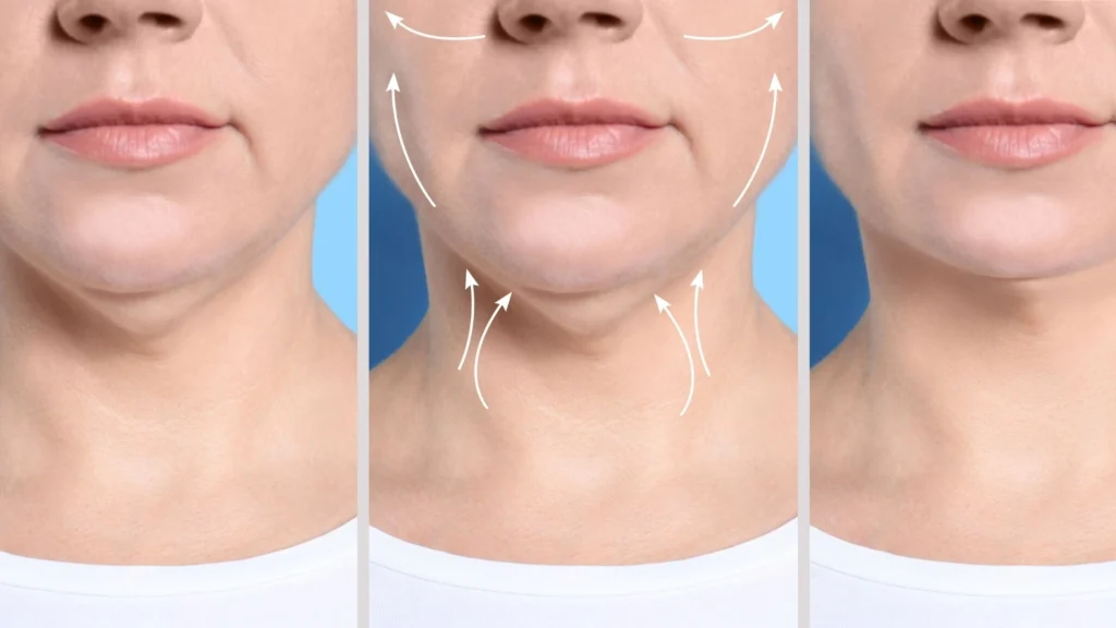double-chin-surgery-results