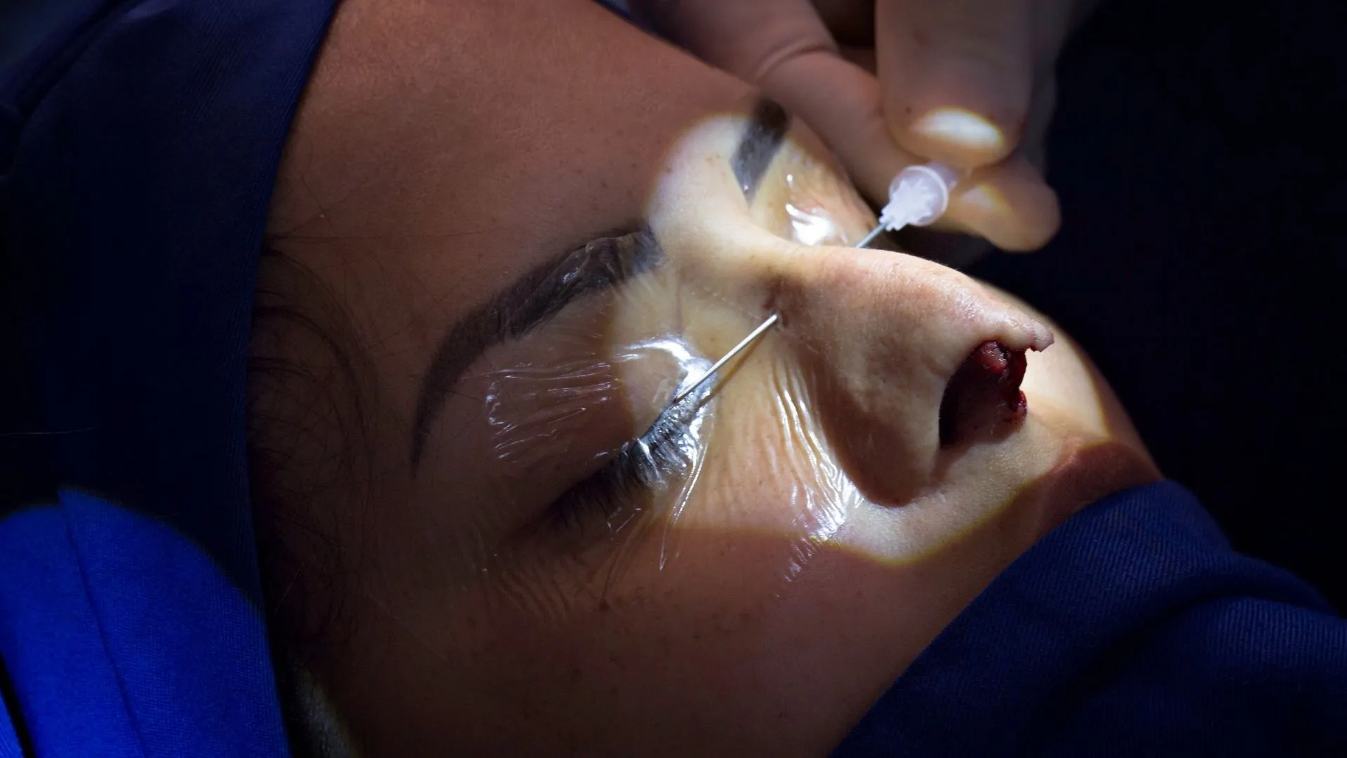 how-should-i-prepare-for-septoplasty-in-turkey-_-Selcuk-Inanli