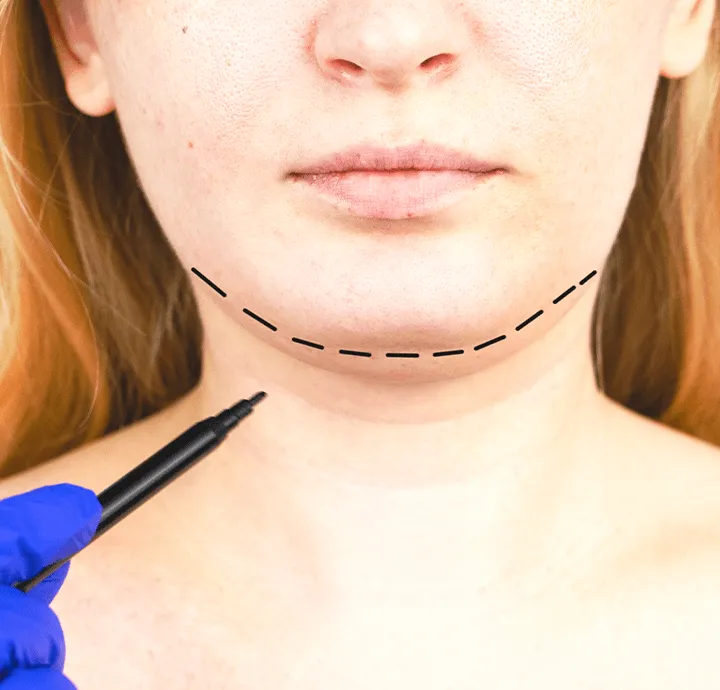 Prof. Dr. Selçuk İnanlı - Rhinoplasty Specialist 6 mentoplasty-selcuk-inanli